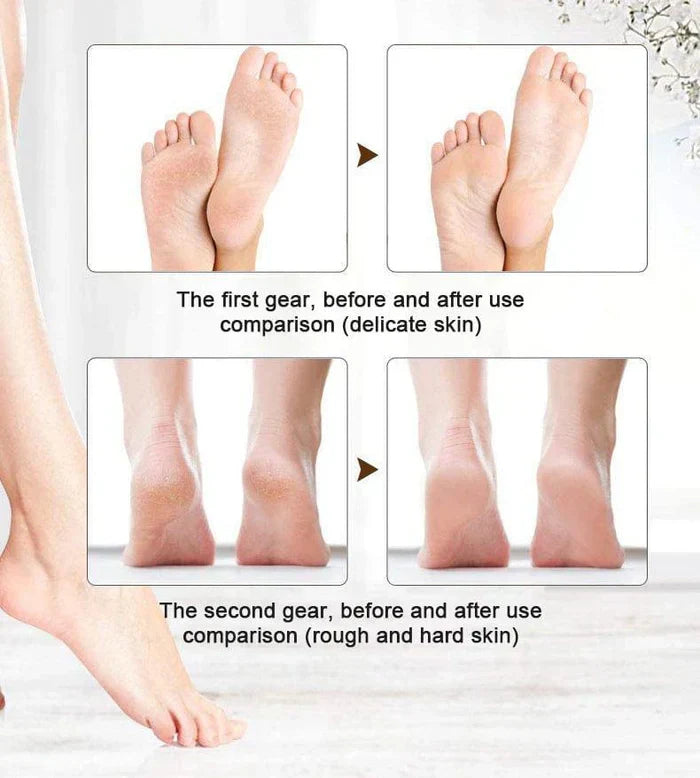 Foot File Callus